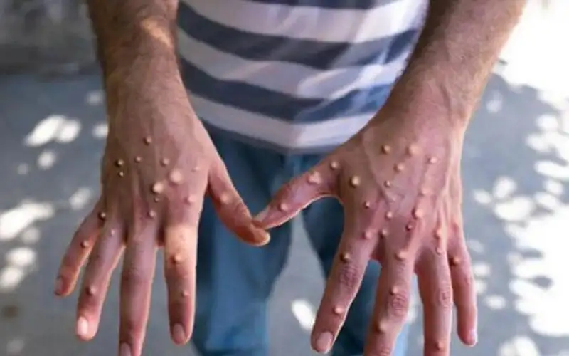 جدري القرود.. هل يصيب الحوامل والأطفال؟