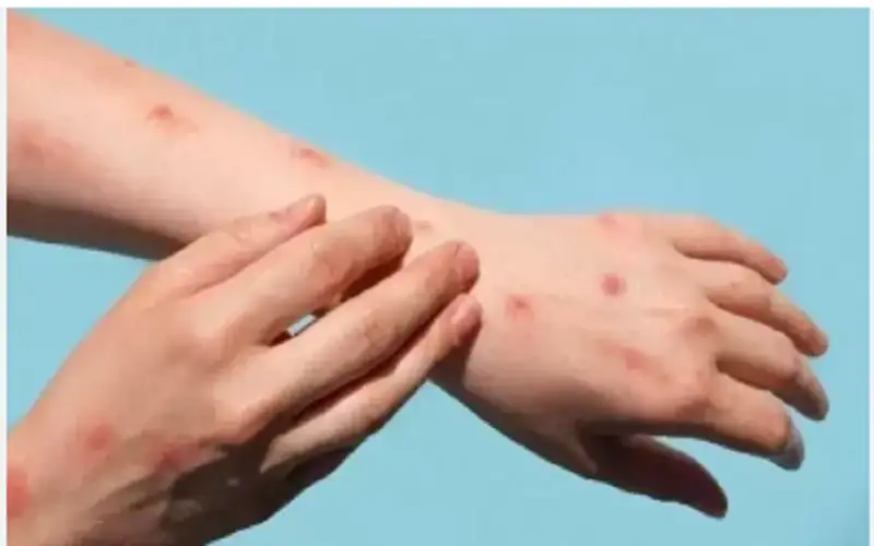 رصد سلالة جديدة لجدري القردة في