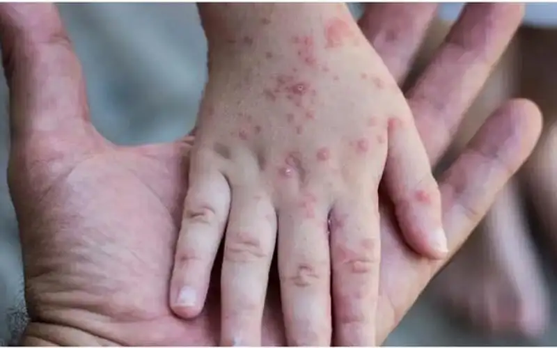 خبراء: تفشي جدري القردة بأفريقيا ناجم