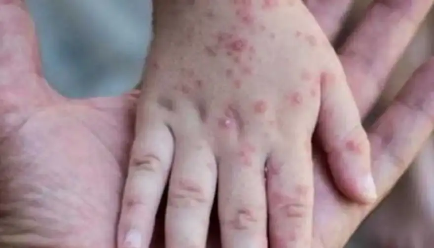 ممثل منظمة الصحة العالمية: كورونا أسرع