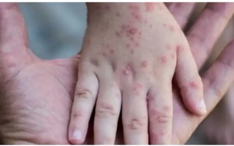 متى يكون جدري القردة معديا وماهي