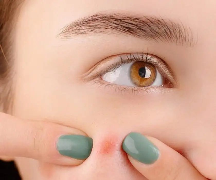 أسباب ظهور الحبوب البكتيرية بالجسم والعلاجات