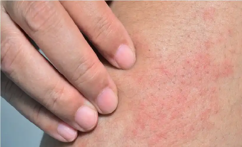 أسباب حكة الساقين والقدمين ومتى ينبغي