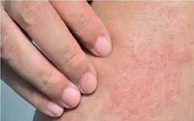 أسباب حكة الساقين والقدمين ومتى ينبغي