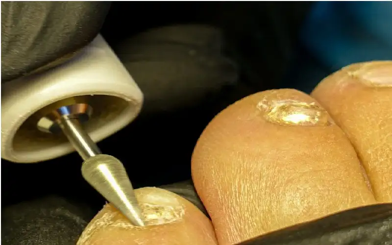 قد يكون الحل النهائي.. الليزر لعلاج