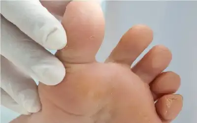أسباب وطرق علاج مسمار القدم