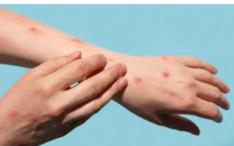 مكافحة الأوبئة: المصاب بجدري القردة في