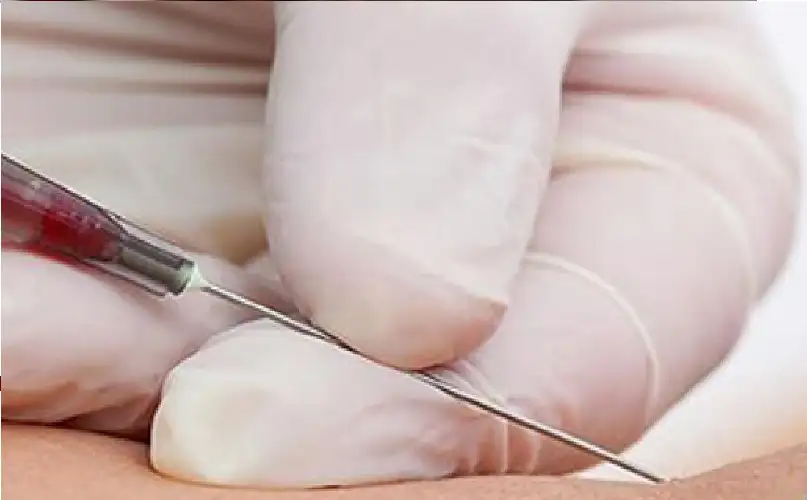 اختبار دم لتشخيص التصلب الجانبي الضموري