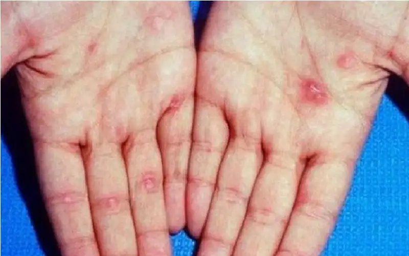 دراسة: بريطانيا تسجل أعلى حالات لـالسيلان