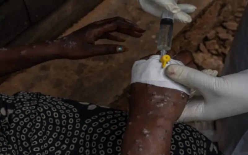 هيئة طبية: جدري القردة خارج نطاق