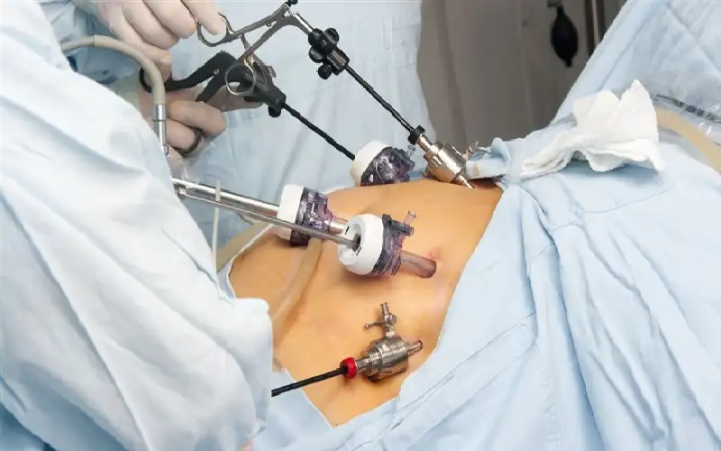 أيهما أكثر فاعلية: جراحة السمنة أم