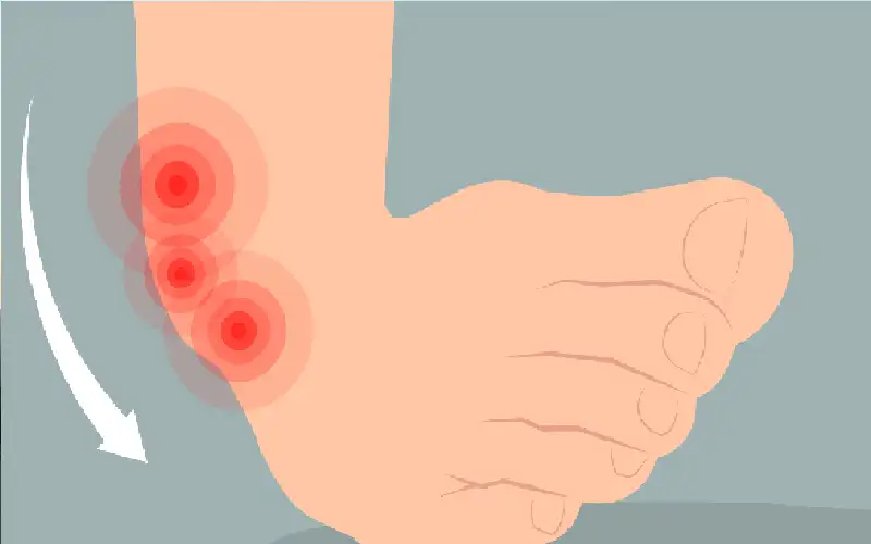 كيف يمكن الإصابة بالالتواء وتمزق الأربطة