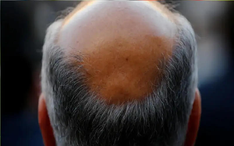 أفضل الطرق لمواجهة الرجال الصلع الوراثي