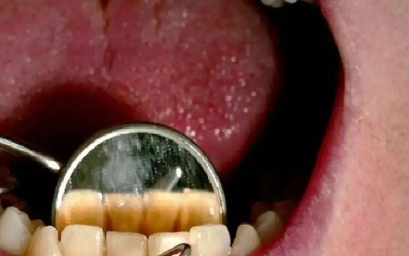 جراثيم أمراض اللثة تضاعف خطر نوعين