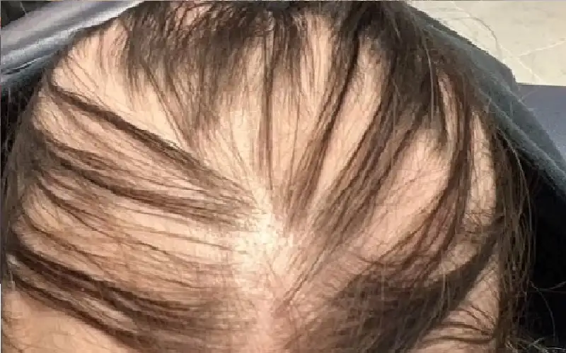 8 إصابات.. كورونا تجعل فتاة صلعاء