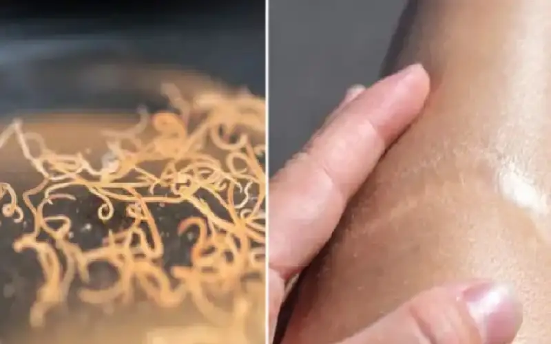 دراسة جديدة: دودة تعمل على علاج