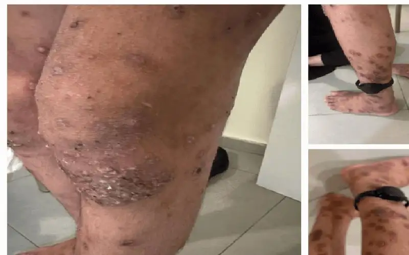 نادي الأسير: الاحتلال يستخدم مرض الجرب