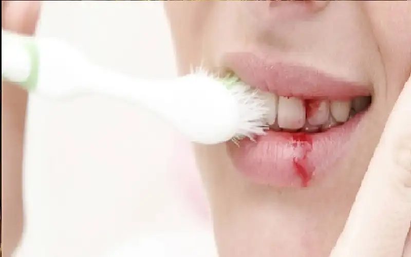 احذر التهاب دواعم اللثة قد يهدد