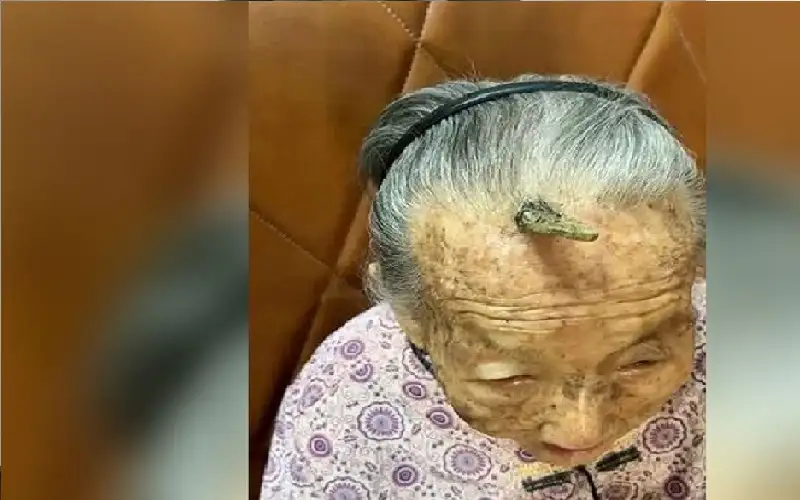 قرن طول العمر ينمو على جبهة