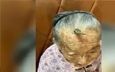 قرن طول العمر ينمو على جبهة