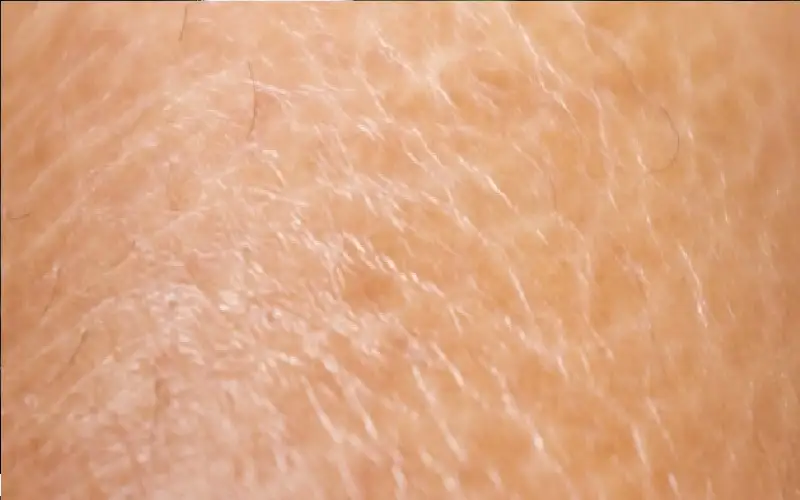 جفاف البشرة بين الأسباب الطبية ونمط