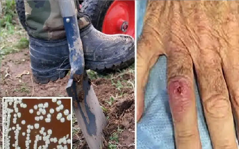 تحذير من عدوى بكتيرية سريعة الانتشار