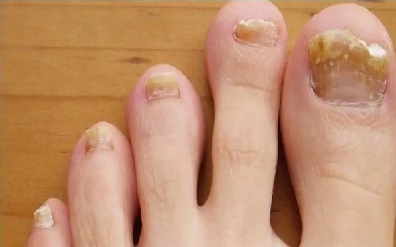 فطريات الأظافر.. أعراضها وطرق الوقاية منها