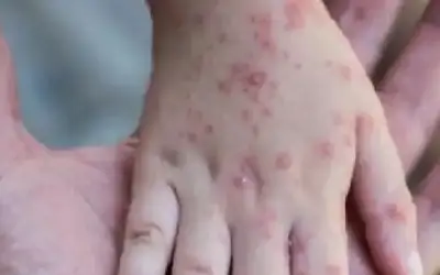 أمريكا تسجل أول إصابة نادرة بجدري