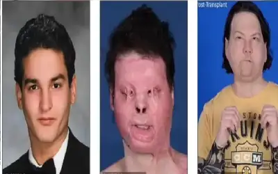 رجل خضع لأول عملية زرع وجه