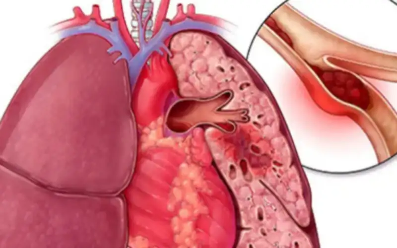 تلوث الهواء يسبب الانسداد الرئوي المزمن