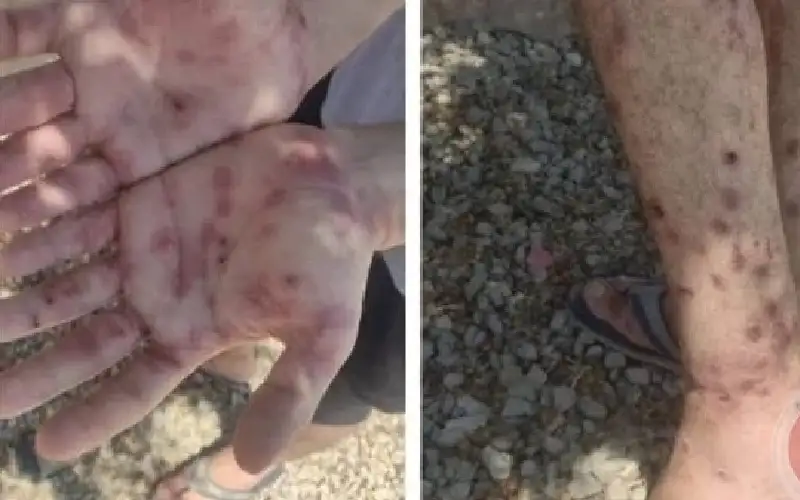 تحقيق: ربع الأسرى أصيبوا بمرض الجرب