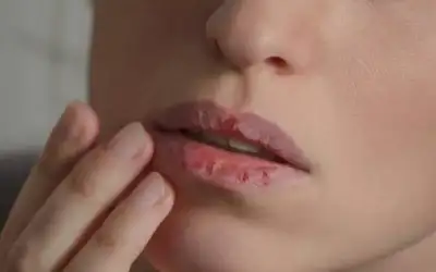كيف نتجنب تشقق الشفاه في الشتاء؟