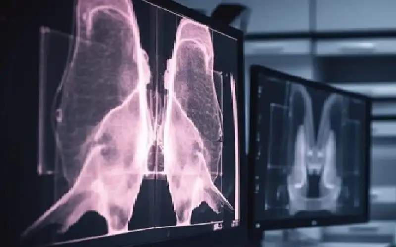 الليزر والذكاء الاصطناعي يكشفان سرطان الثدي