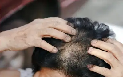 ما علاقة تساقط الشعر بالصيام المتقطع؟