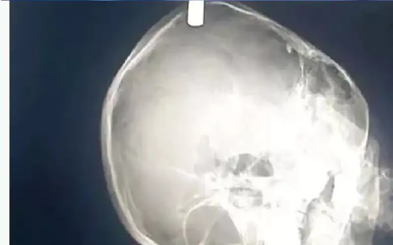 بسبب حادث دراجة.. نجاة طفل بعد