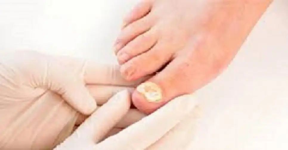 نصائح طبية لعلاج فطريات الأظافر بطرق