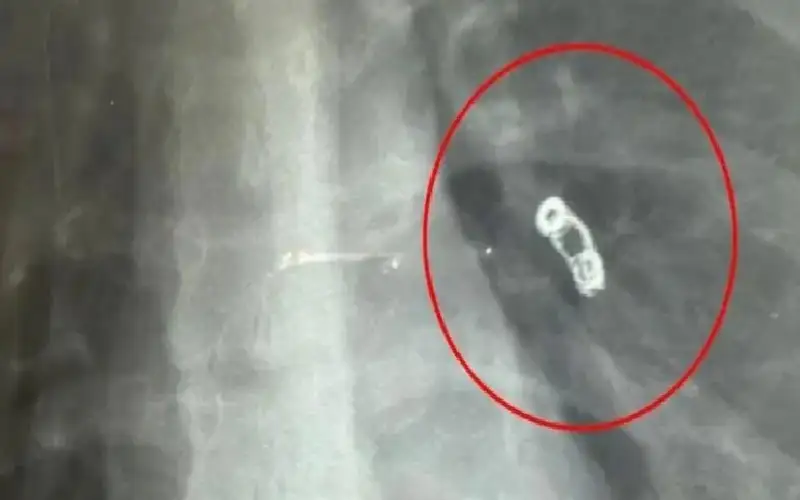 روسية تكتشف كارثة في الرئة بعد