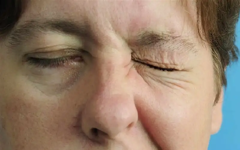 العصب السابع.. الأسباب والأعراض وطرق الوقاية