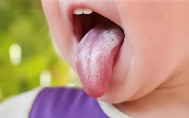 اعرف حالتك الصحية من لون لسانك