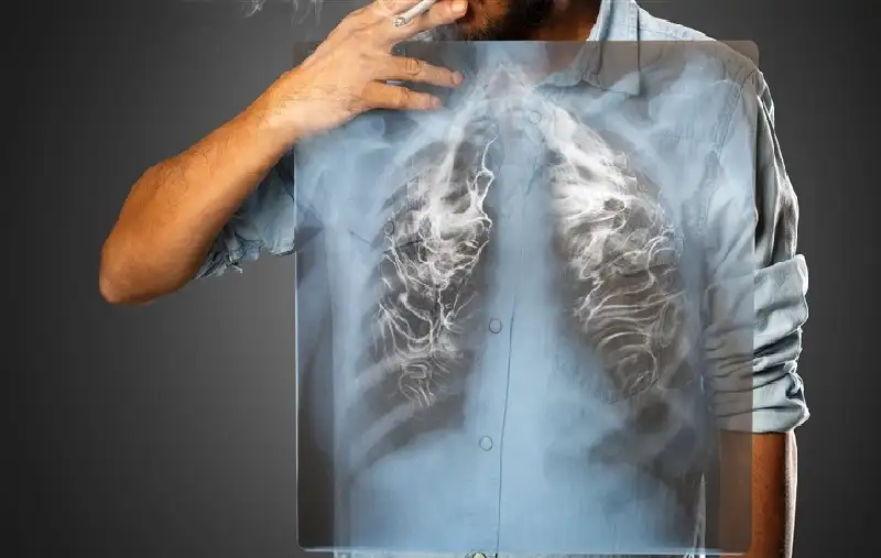 التدخين المبكر يفاقم مخاطر الانسداد الرئوي