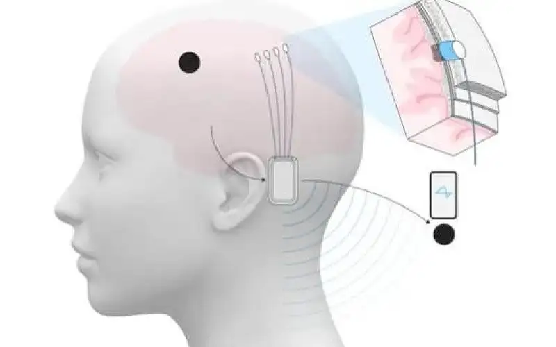 ماسك يعلن نجاح زرع شريحة دماغية