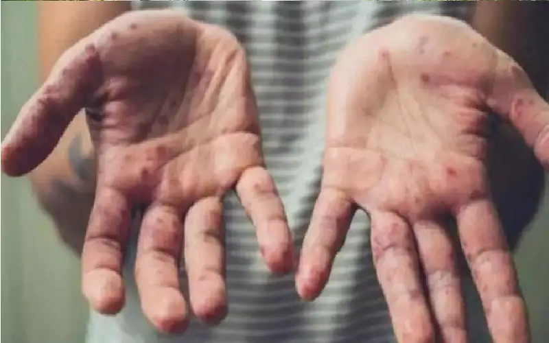 سيراليون تسجل أول إصابة بمرض جدري