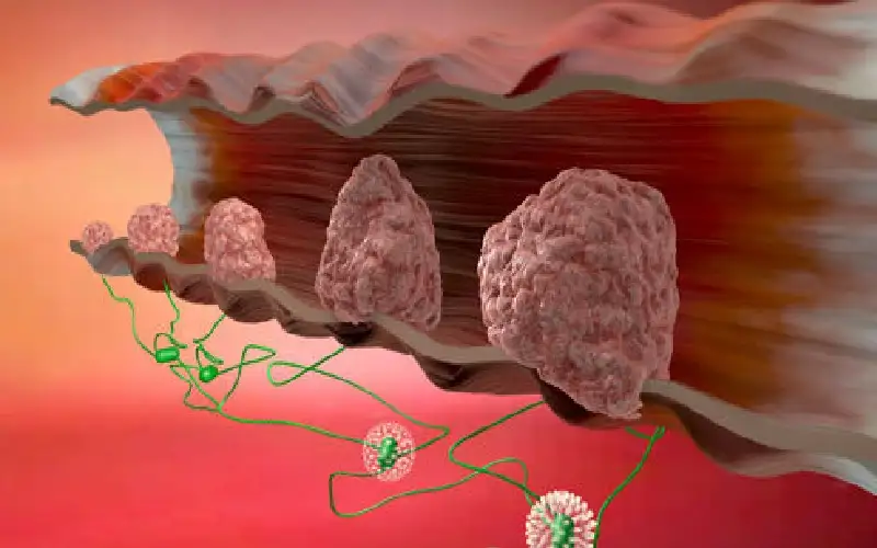 سرطان الأمعاء بين الشباب.. أرقام مروعة