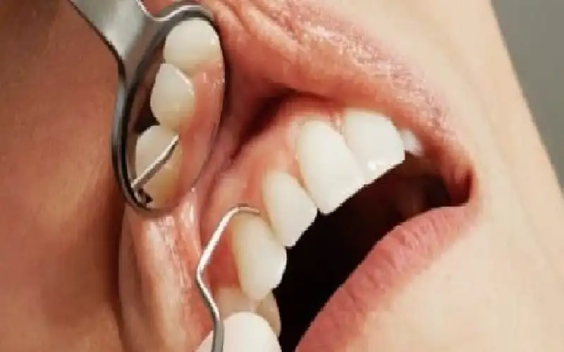 التهابات اللثة تتسلل إلى المخ وتؤدي