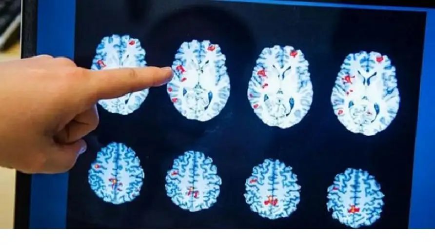 غاز تخدير قد يكون العلاج القادم