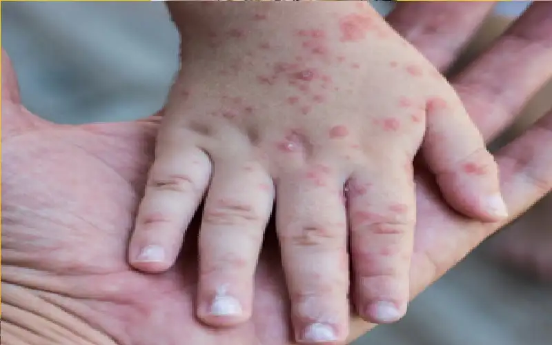 انتشار غير عادي للحصبة في المغرب..