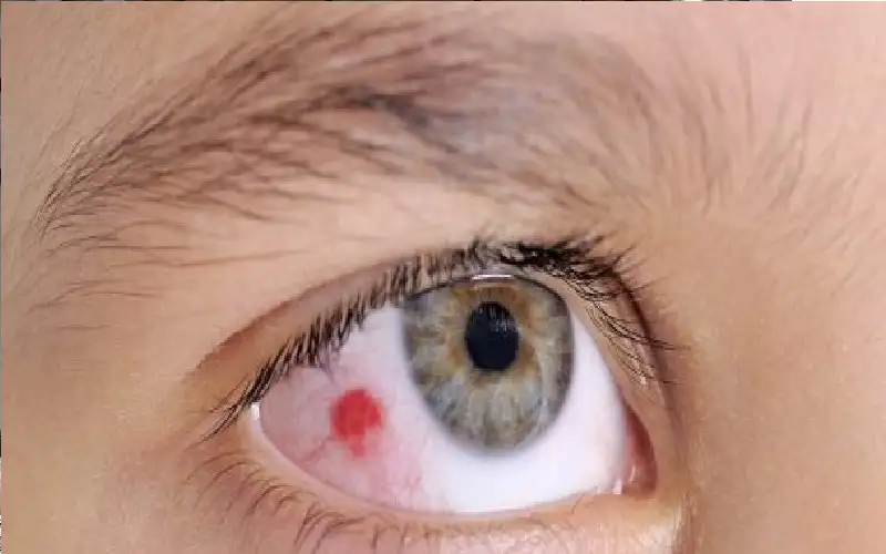 7 علامات رئيسية لسرطان العين يجب