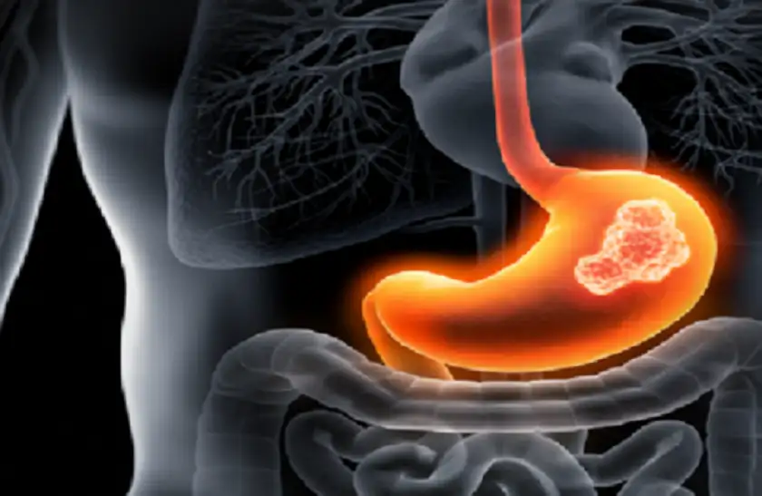 أفضل الخيارات الغذائية في حالة التهاب