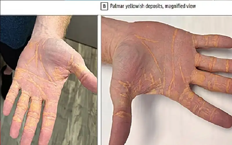 بسبب أكل لأطعمة الحيوانية فقط.. عقد
