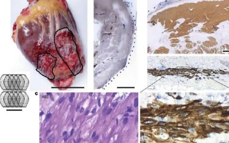 ثورة في علاج قصور القلب.. رقعة